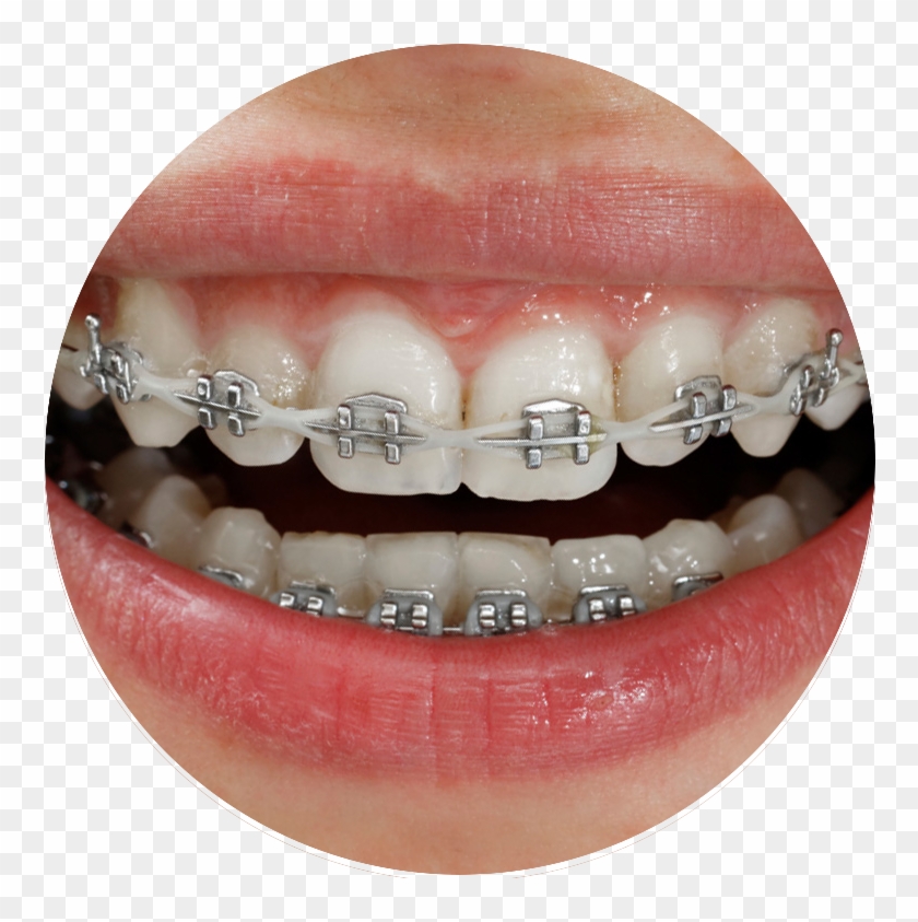 Titanium Braces Ceramic Braces, HD Png Download 762x763 (1416506