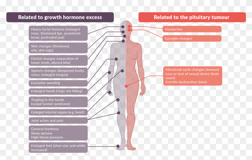 Acromegaly Symptoms Standing, HD Png Download 1170x676 (3340639