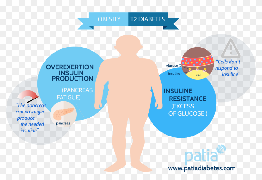 Сахарный диабет 2 типа при ожирении. Ожирение. obesity and diabetes. сахарный диабет ожирение. obesitydiabetes.